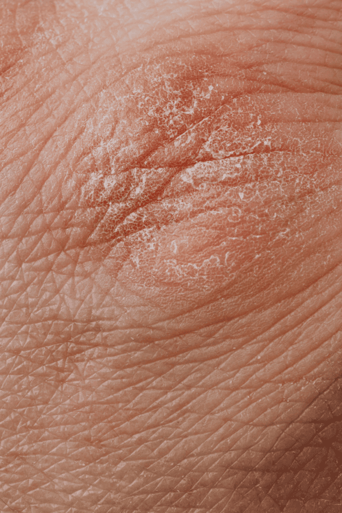 Psoriasis skin condition that water fasting can help by reducing inflammation and supporting immune reset