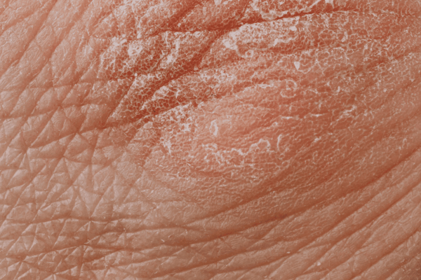 Psoriasis skin condition that water fasting can help by reducing inflammation and supporting immune reset